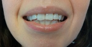 Invisible Tooth Alignment